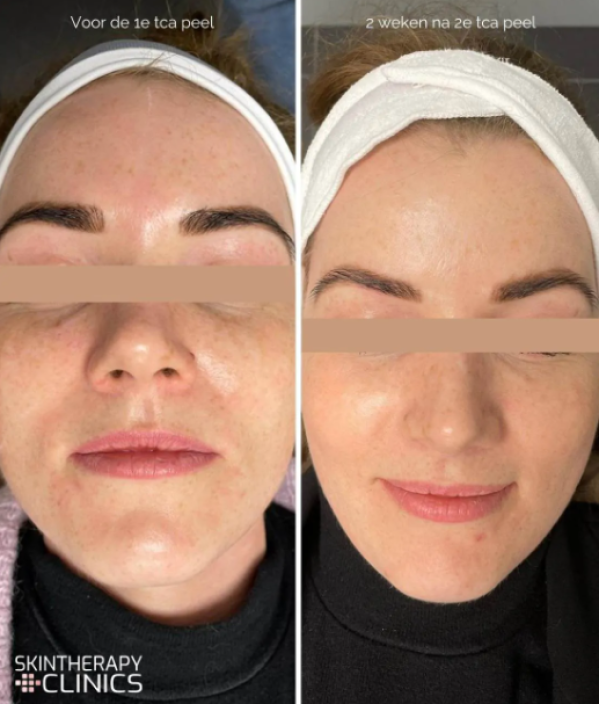 resultaat tca peeling