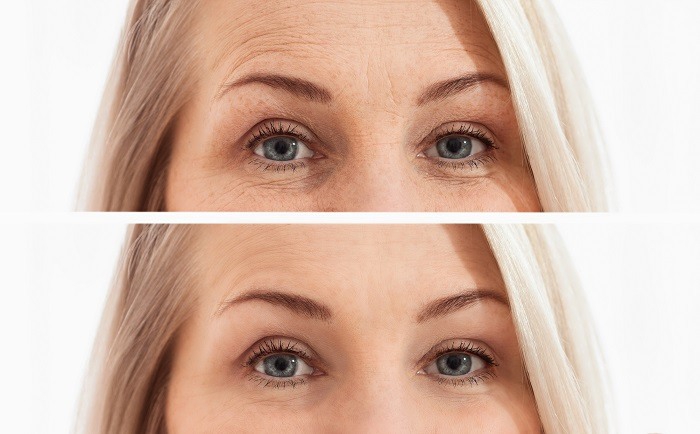Mesotherapie before after