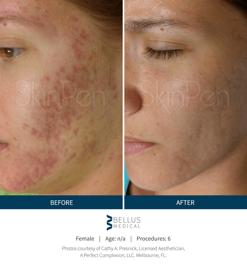 Microneedling before and after